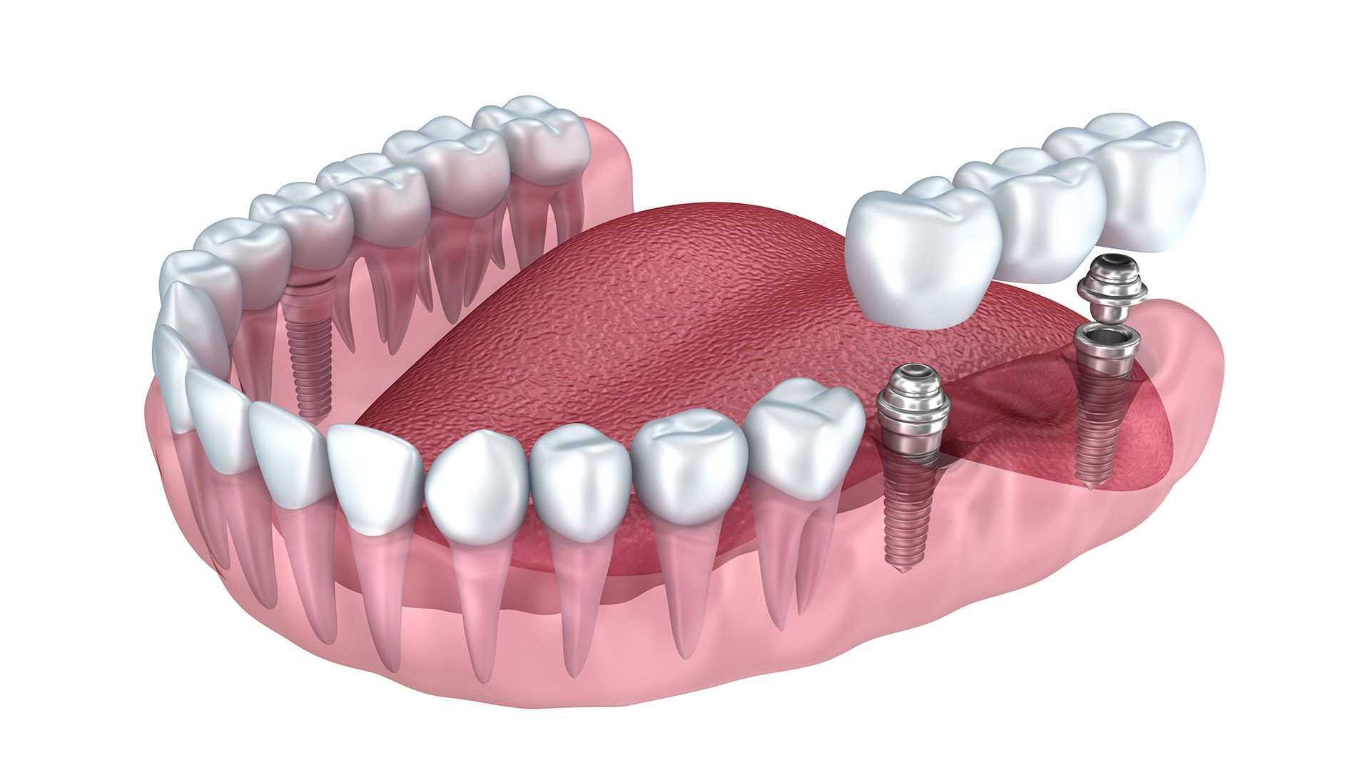 Keramikimplantate Bielefeld